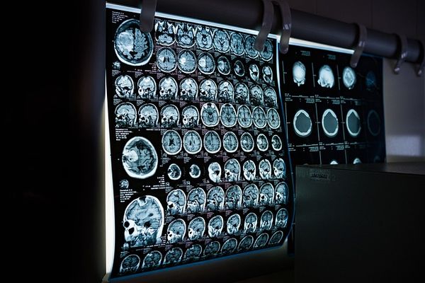 Nowoczesne metody diagnostyki neurologicznej - przegląd najważniejszych